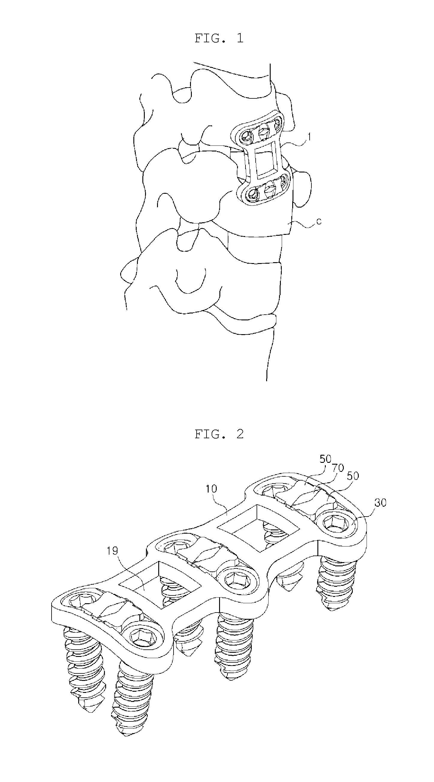 Spine fixing apparatus