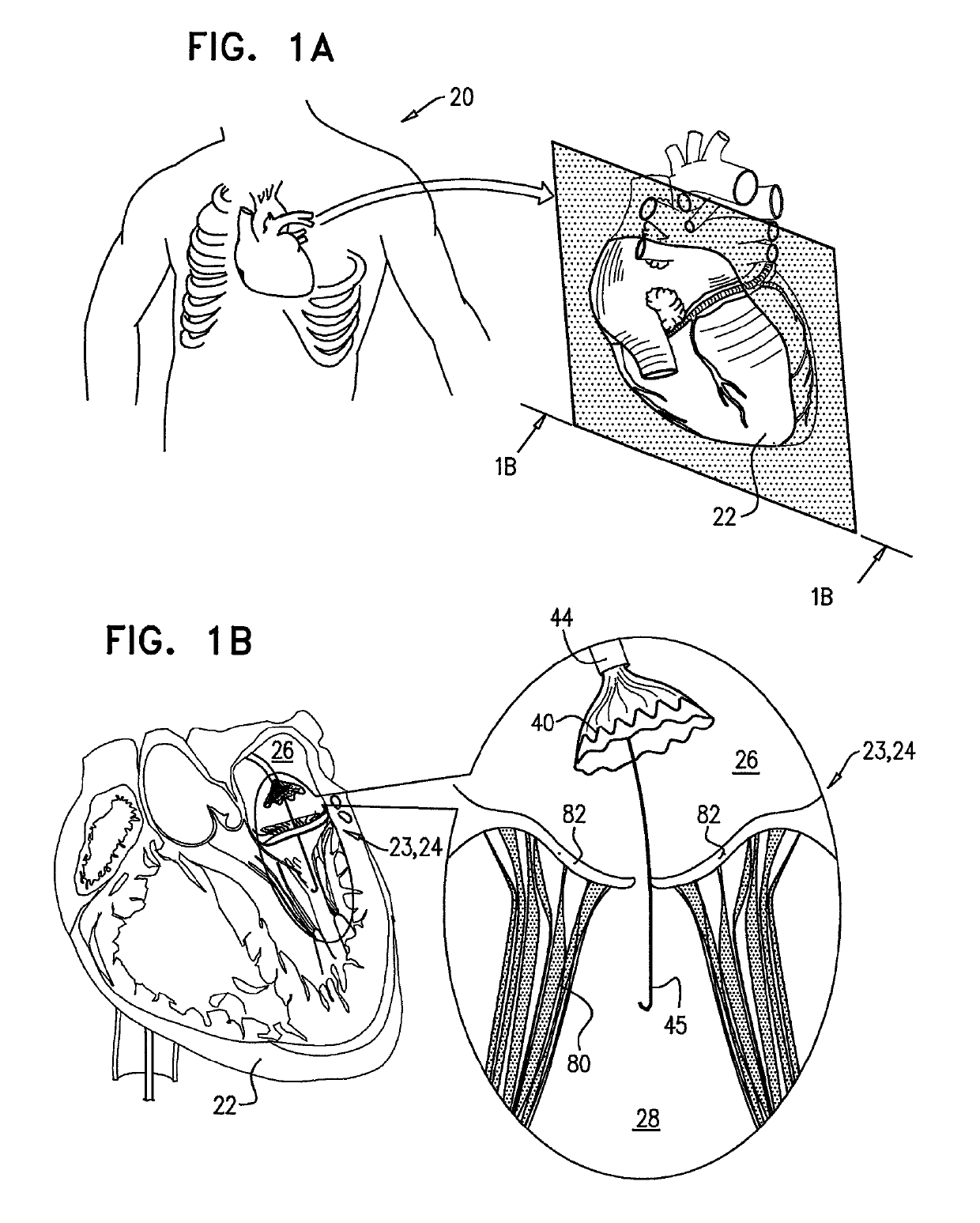 Techniques for percutaneous mitral valve replacement and sealing