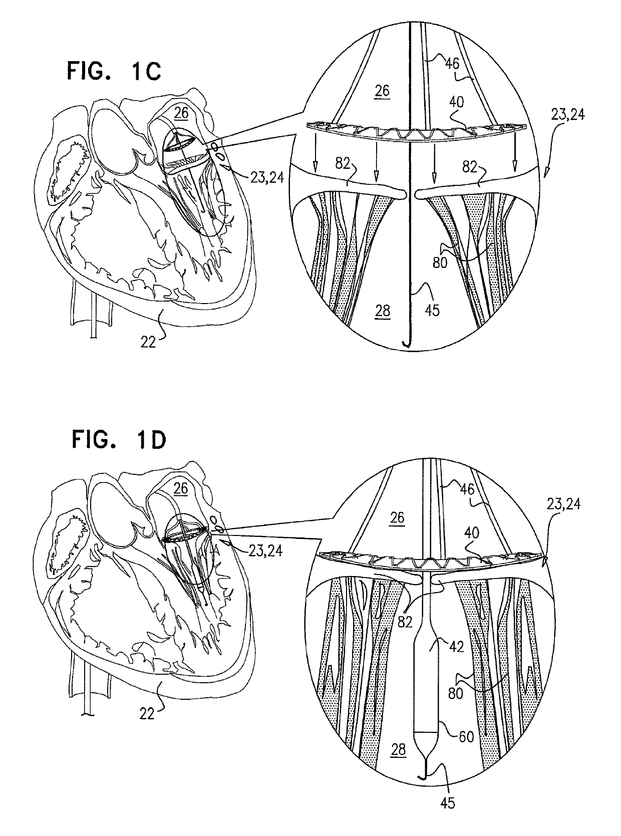 Techniques for percutaneous mitral valve replacement and sealing