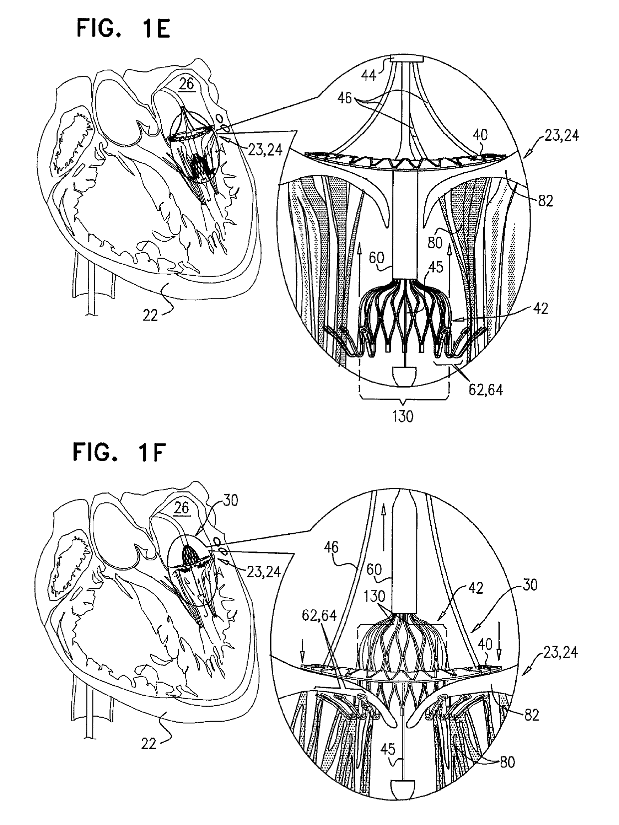 Techniques for percutaneous mitral valve replacement and sealing