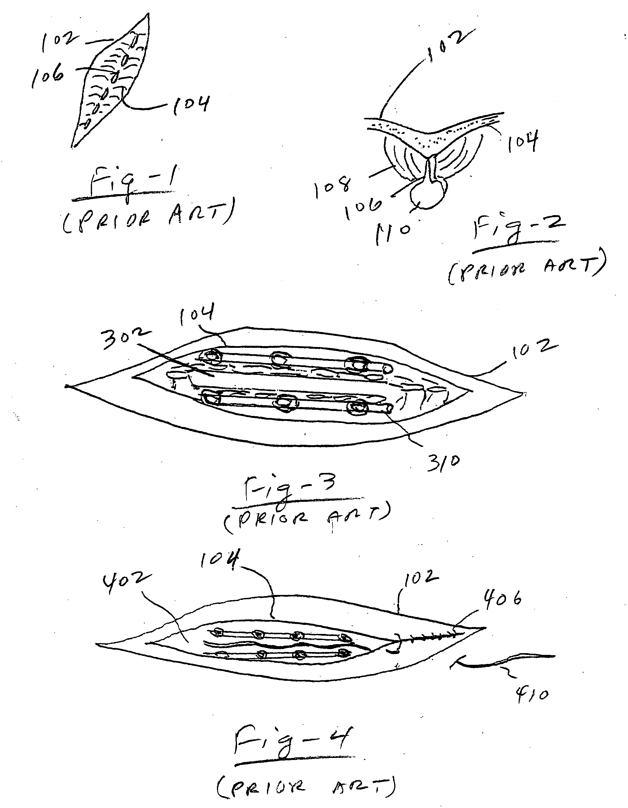 Deep fascia anchors