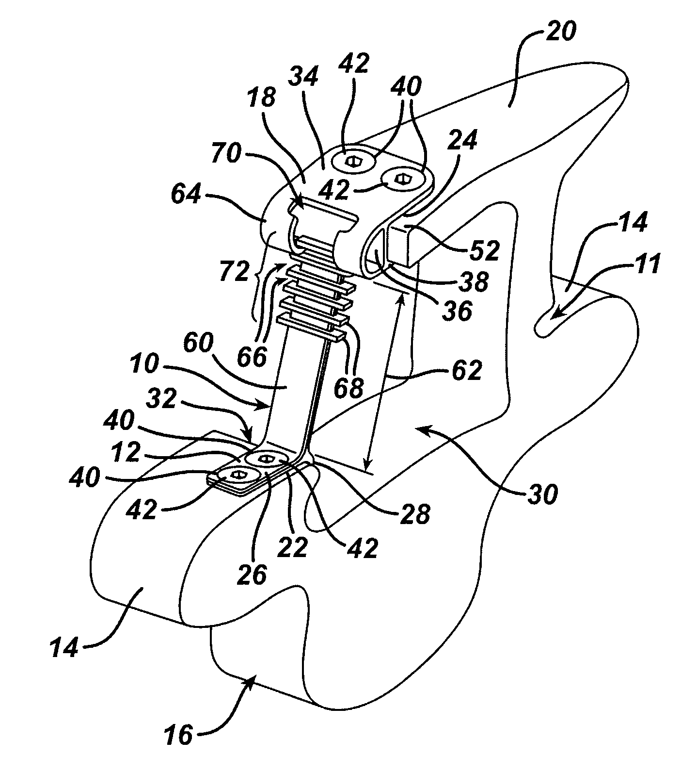 Variable laminoplasty implant