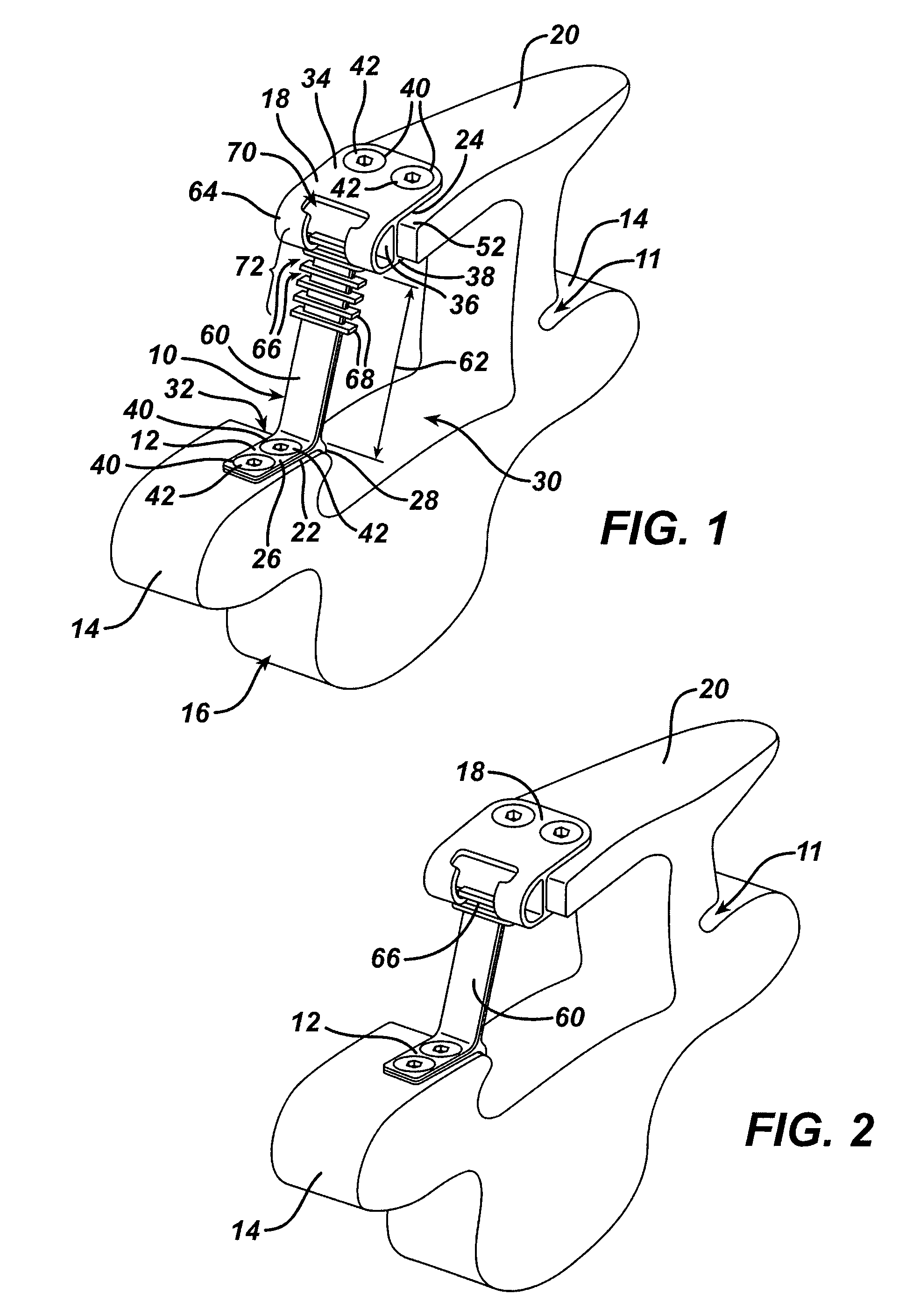 Variable laminoplasty implant