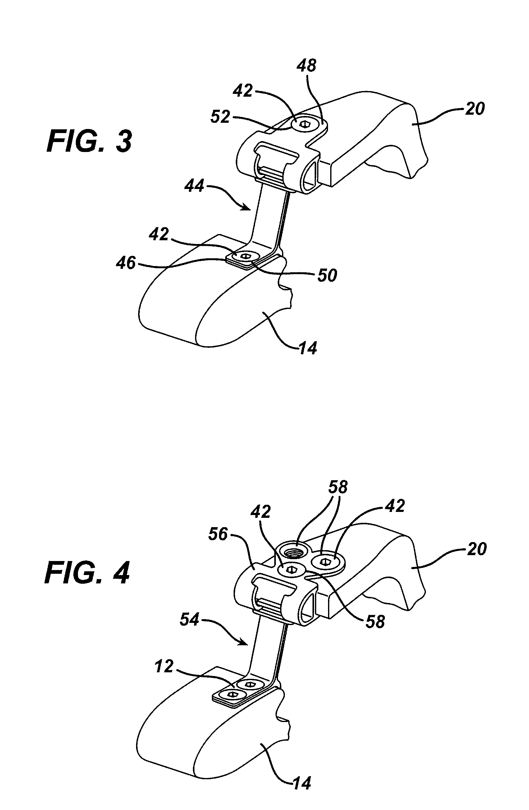 Variable laminoplasty implant