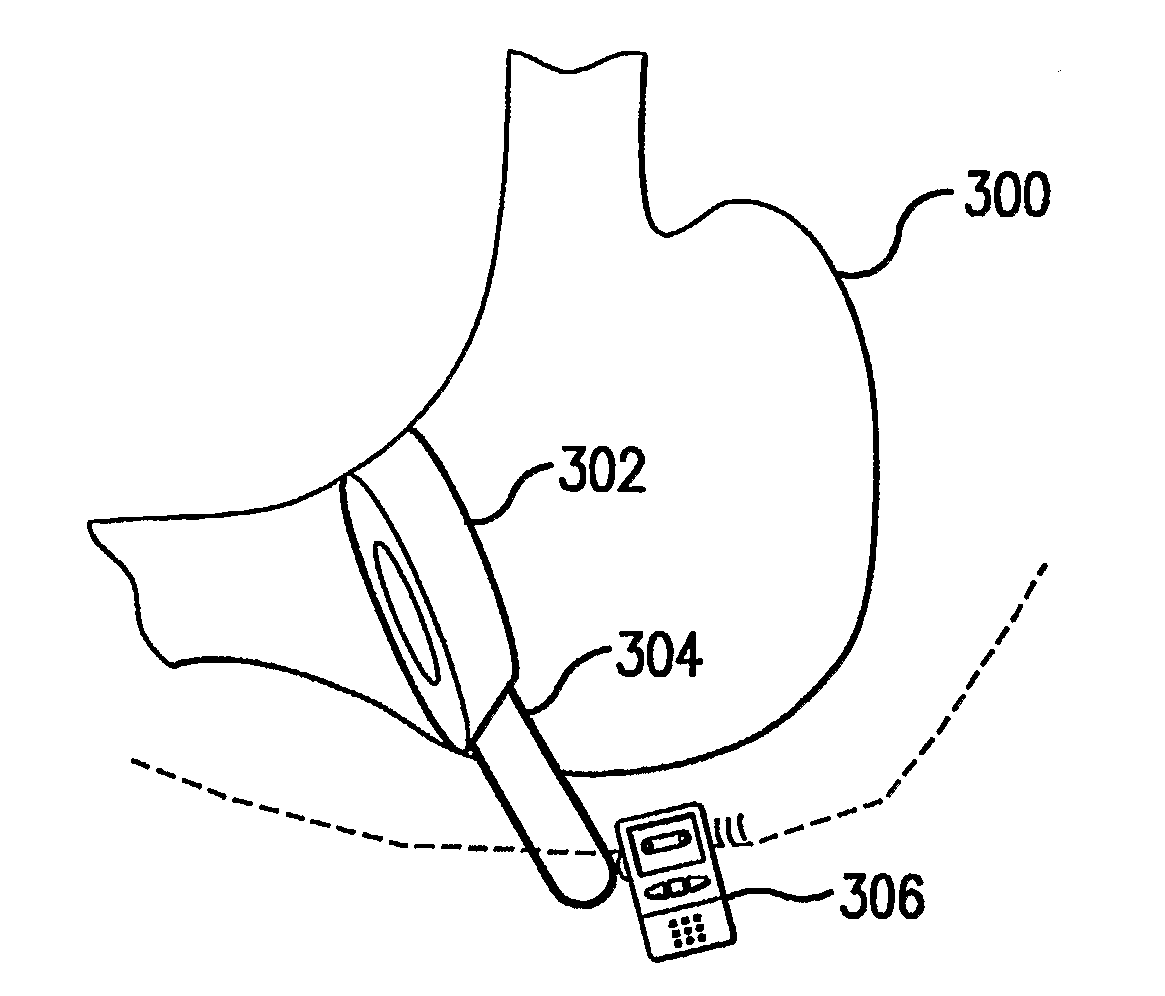 Methods and Devices for Treating Obesity