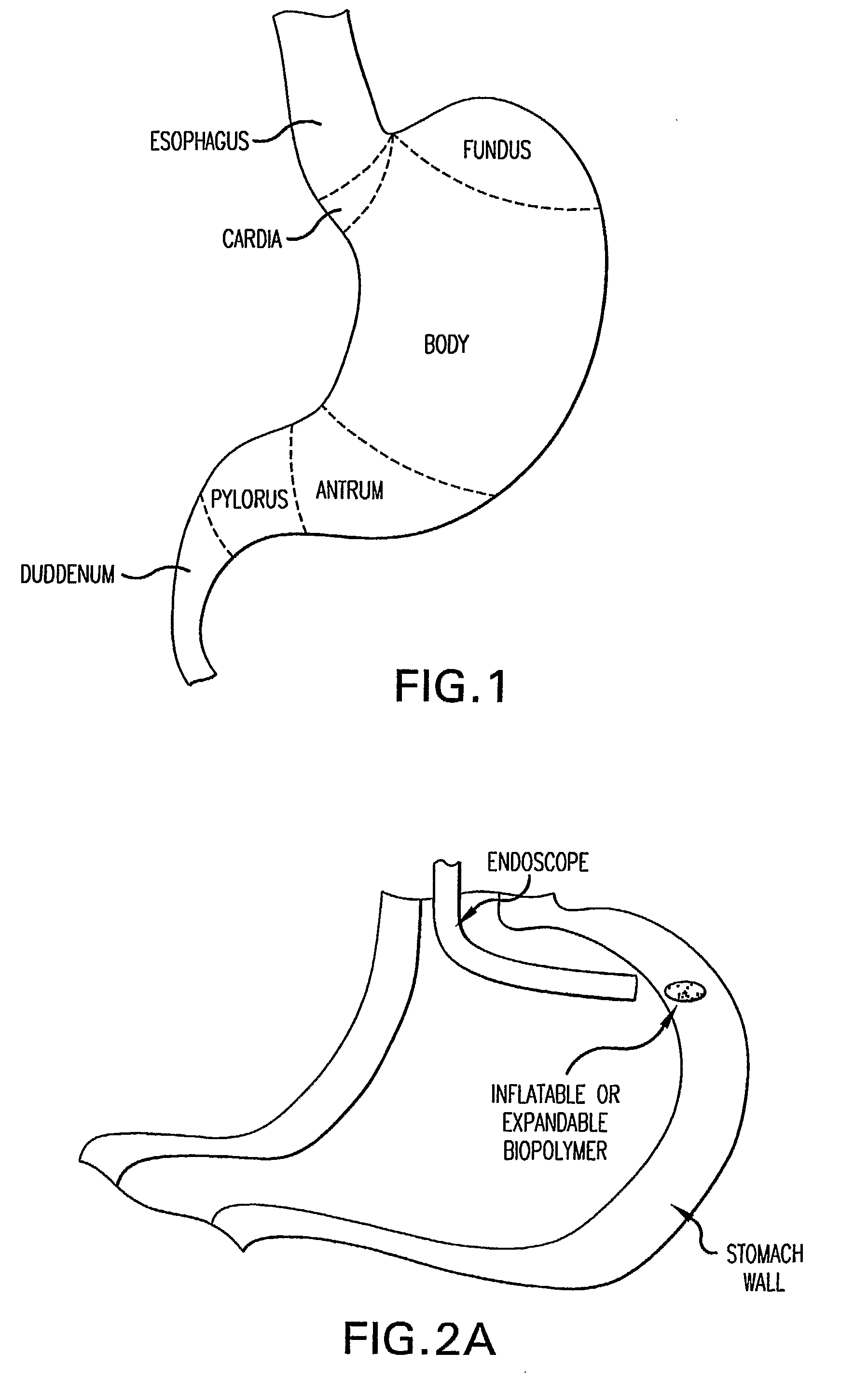 Methods and Devices for Treating Obesity