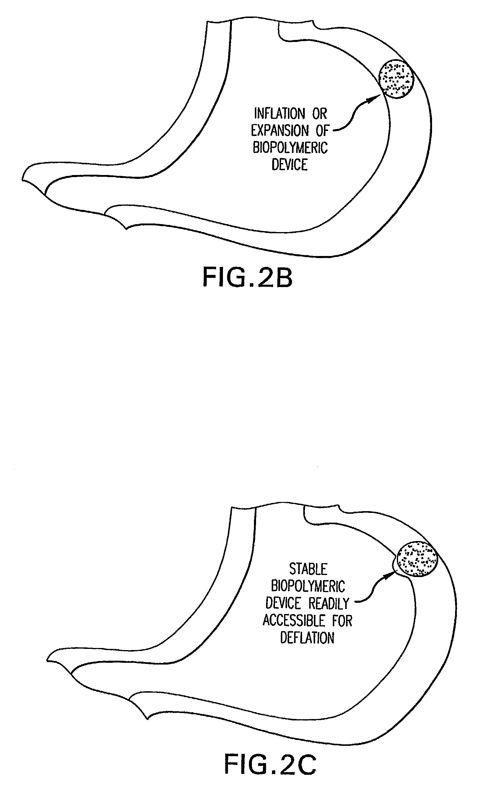 Methods and Devices for Treating Obesity