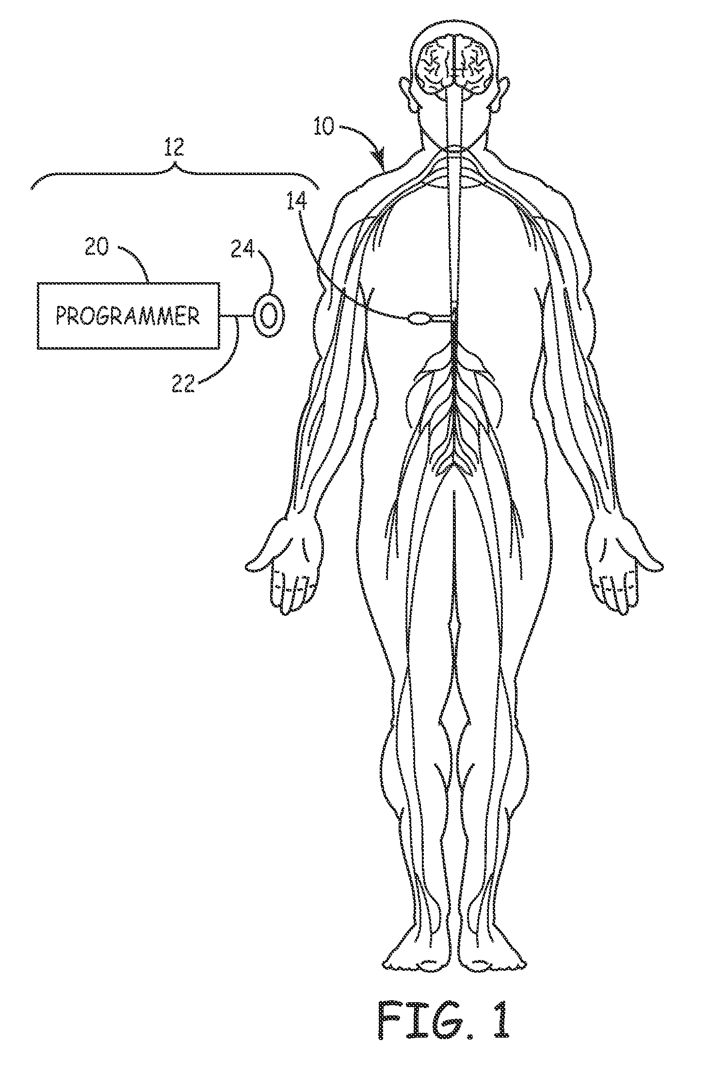 Interface for implantable medical device programming