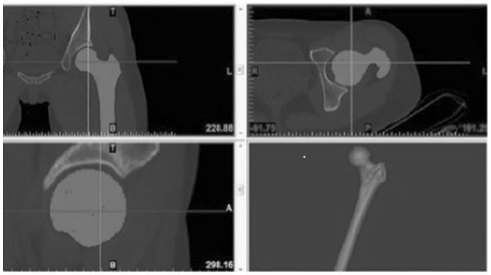 Manufacturing method of personalized absorbable support bone grafting plate for developmental dysplasia of hip