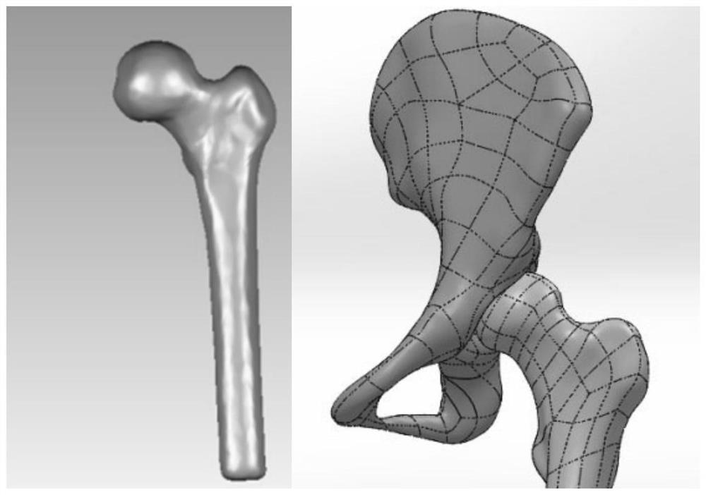 Manufacturing method of personalized absorbable support bone grafting plate for developmental dysplasia of hip