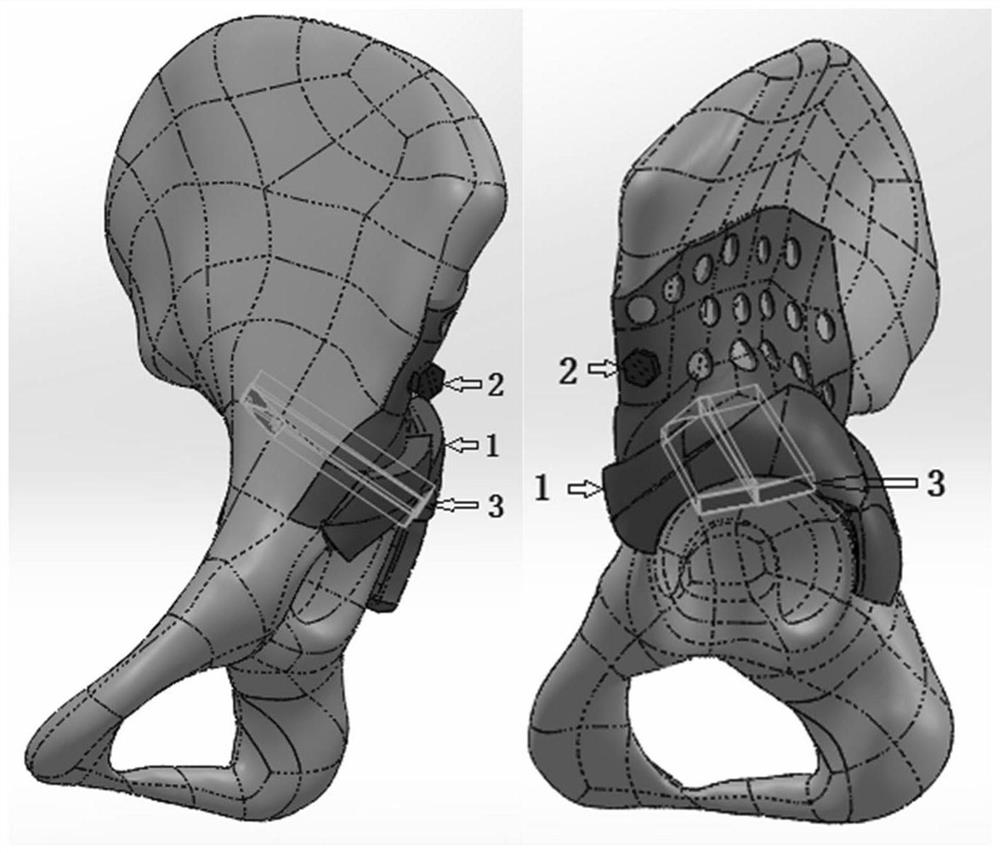 Manufacturing method of personalized absorbable support bone grafting plate for developmental dysplasia of hip