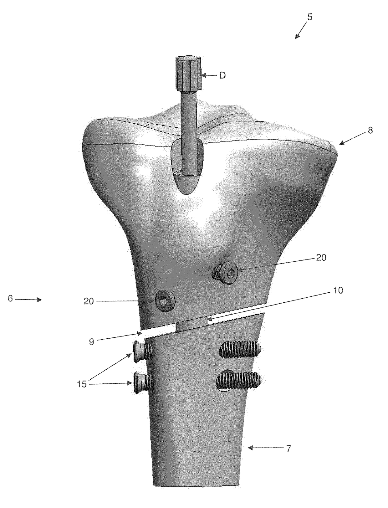 Interlocking intramedullary rod assembly for treating proximal tibial fractures