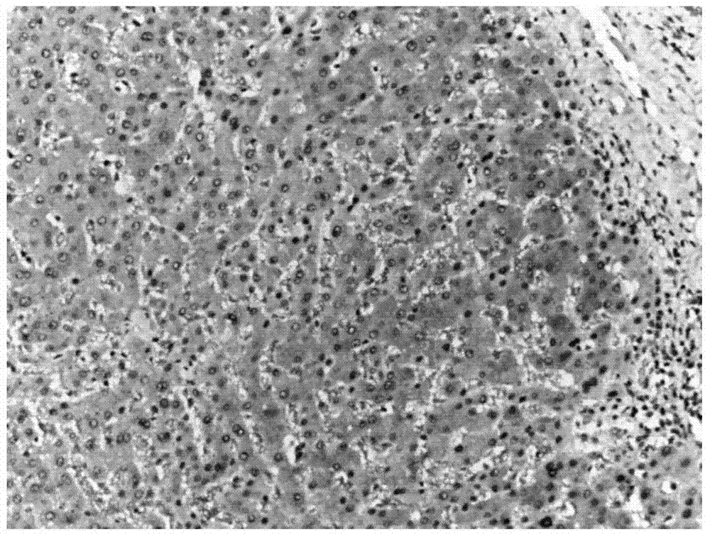 Double-stained kit for auxiliary diagnosis of benign or malignant hepatocellular tumor and application thereof