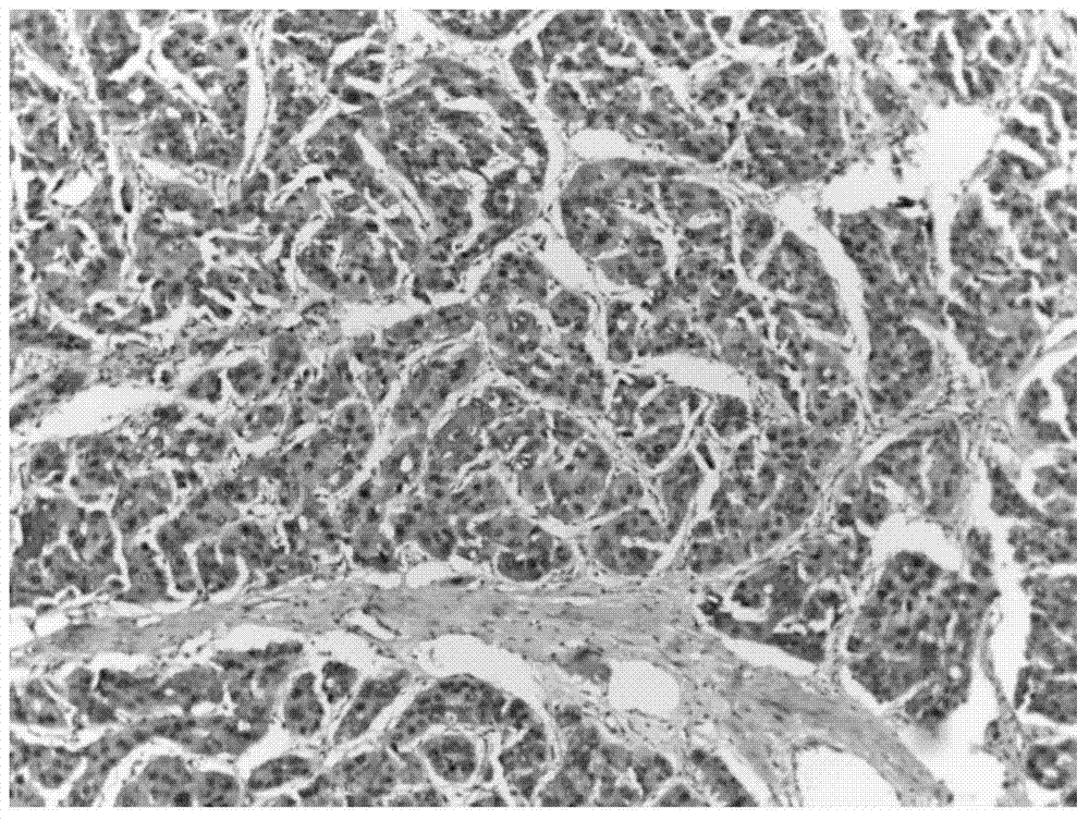 Double-stained kit for auxiliary diagnosis of benign or malignant hepatocellular tumor and application thereof