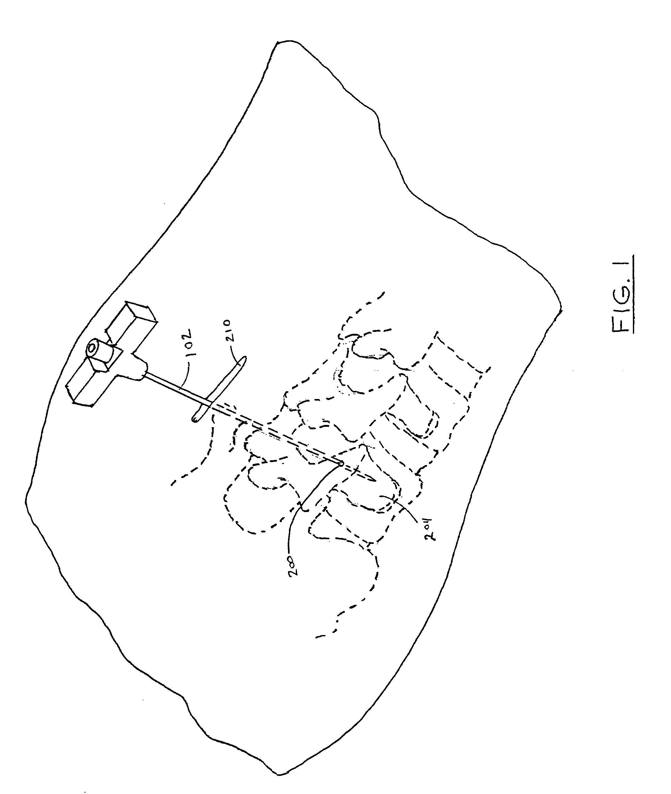 Sleeve assembly for spinal stabilization system and methods of use