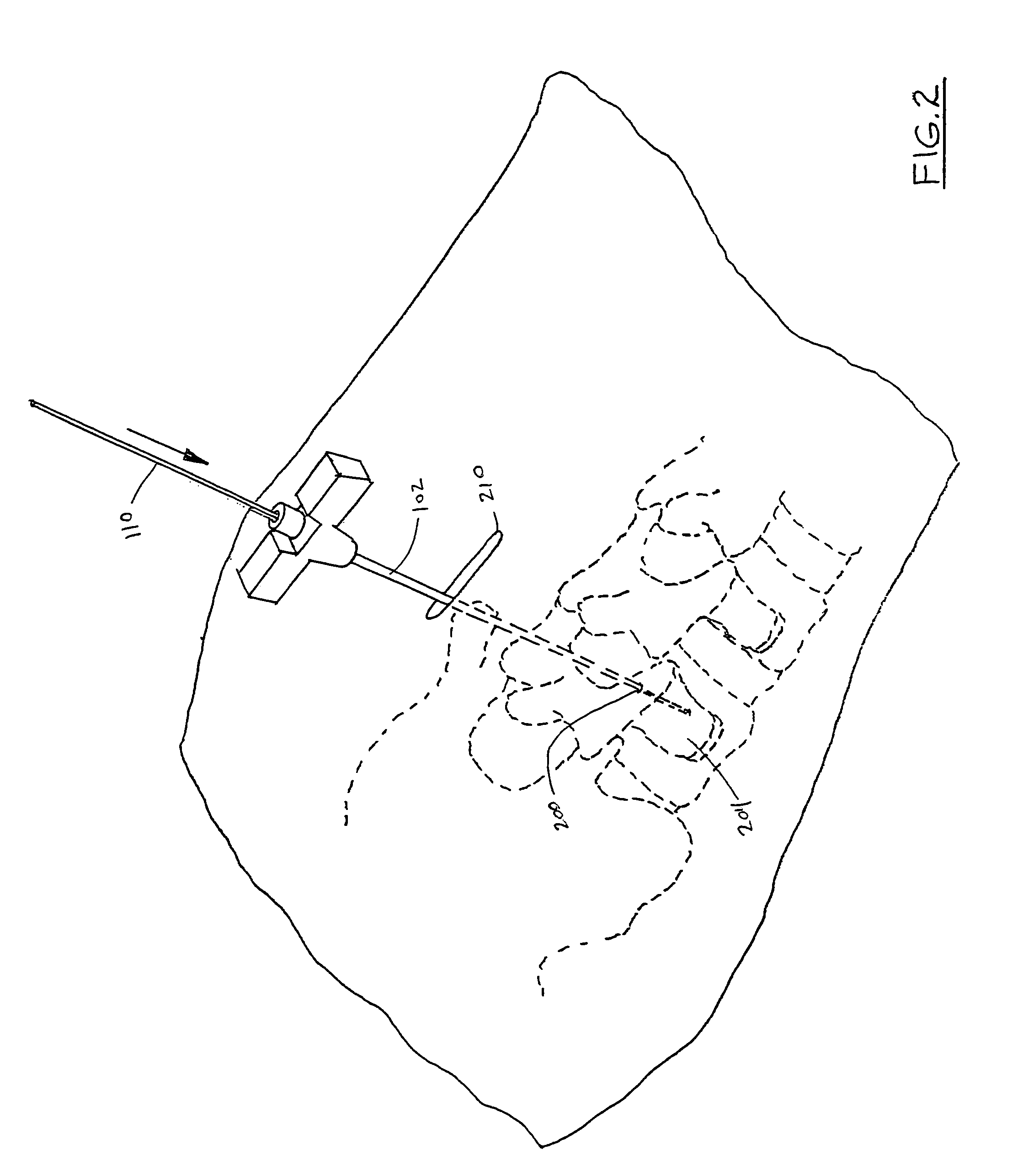 Sleeve assembly for spinal stabilization system and methods of use