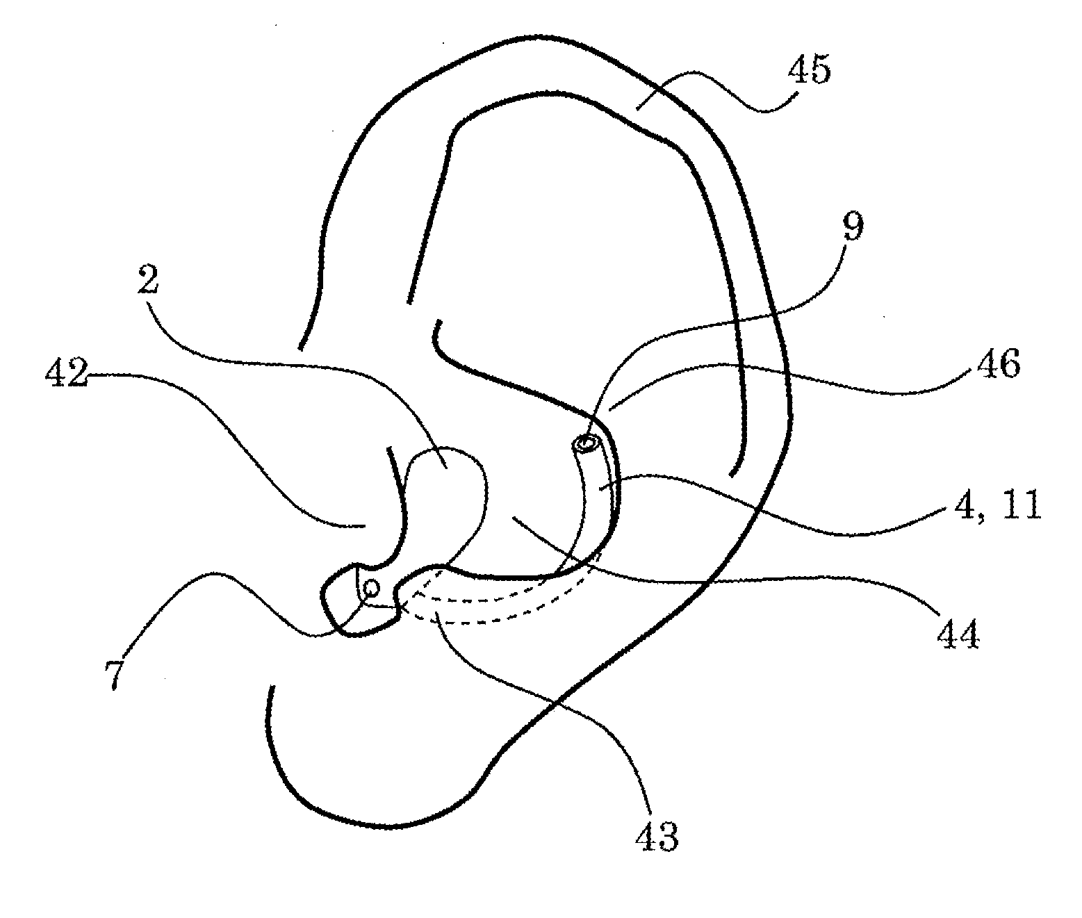 Hearing device with a vent extension and method for manufacturing such a hearing device