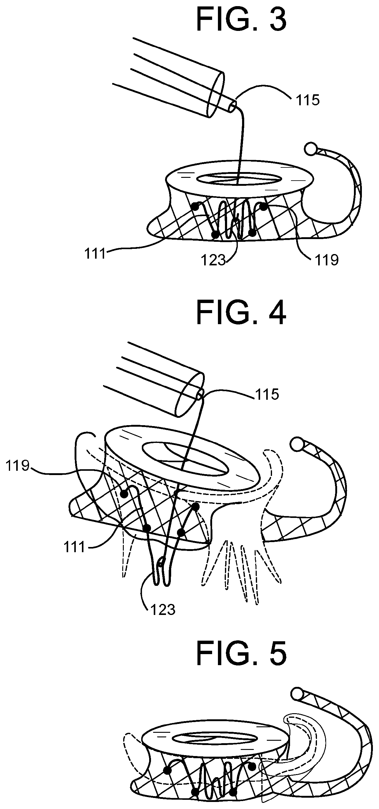 A2 Clip for Side-Delivered Transcatheter Mitral Valve Prosthesis