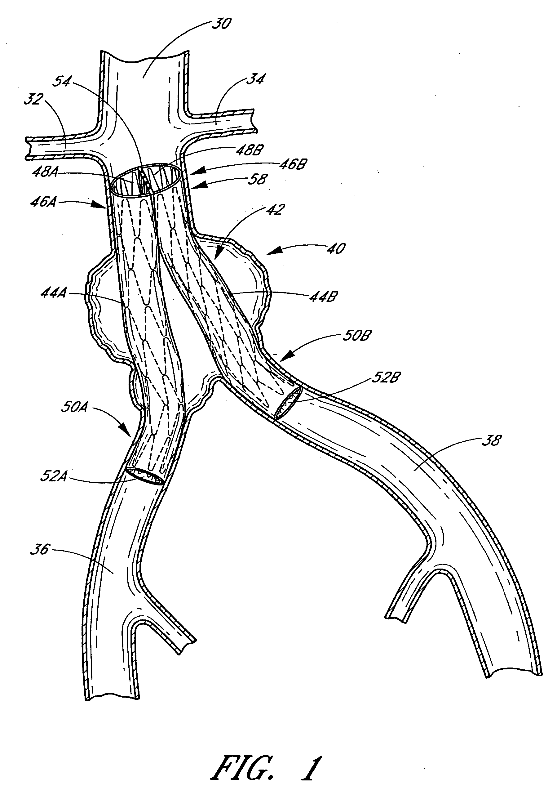 Vascular graft and deployment system