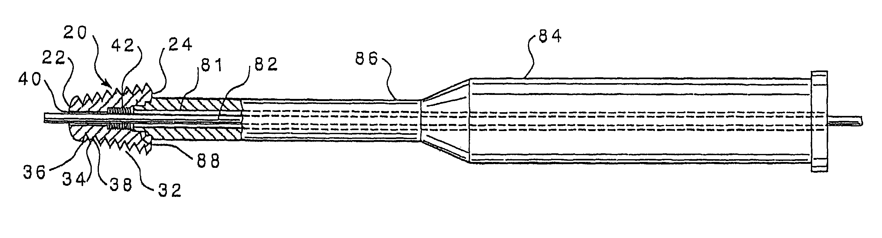 Subtalar implant and methods of use thereof