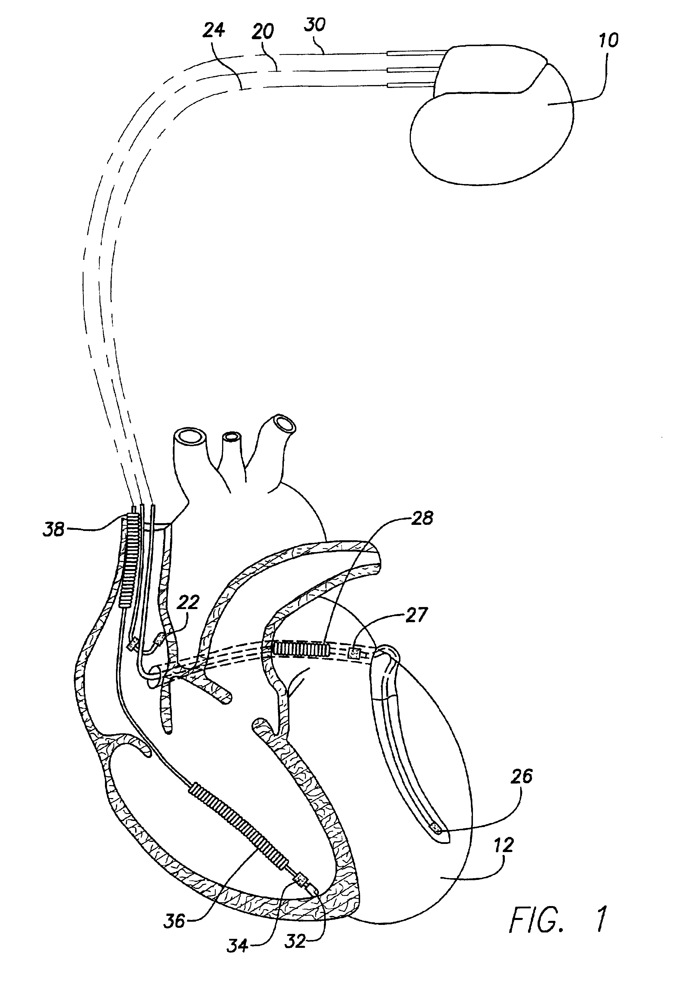 Implantable cardiac stimulation device having automatic sensitivity control and method