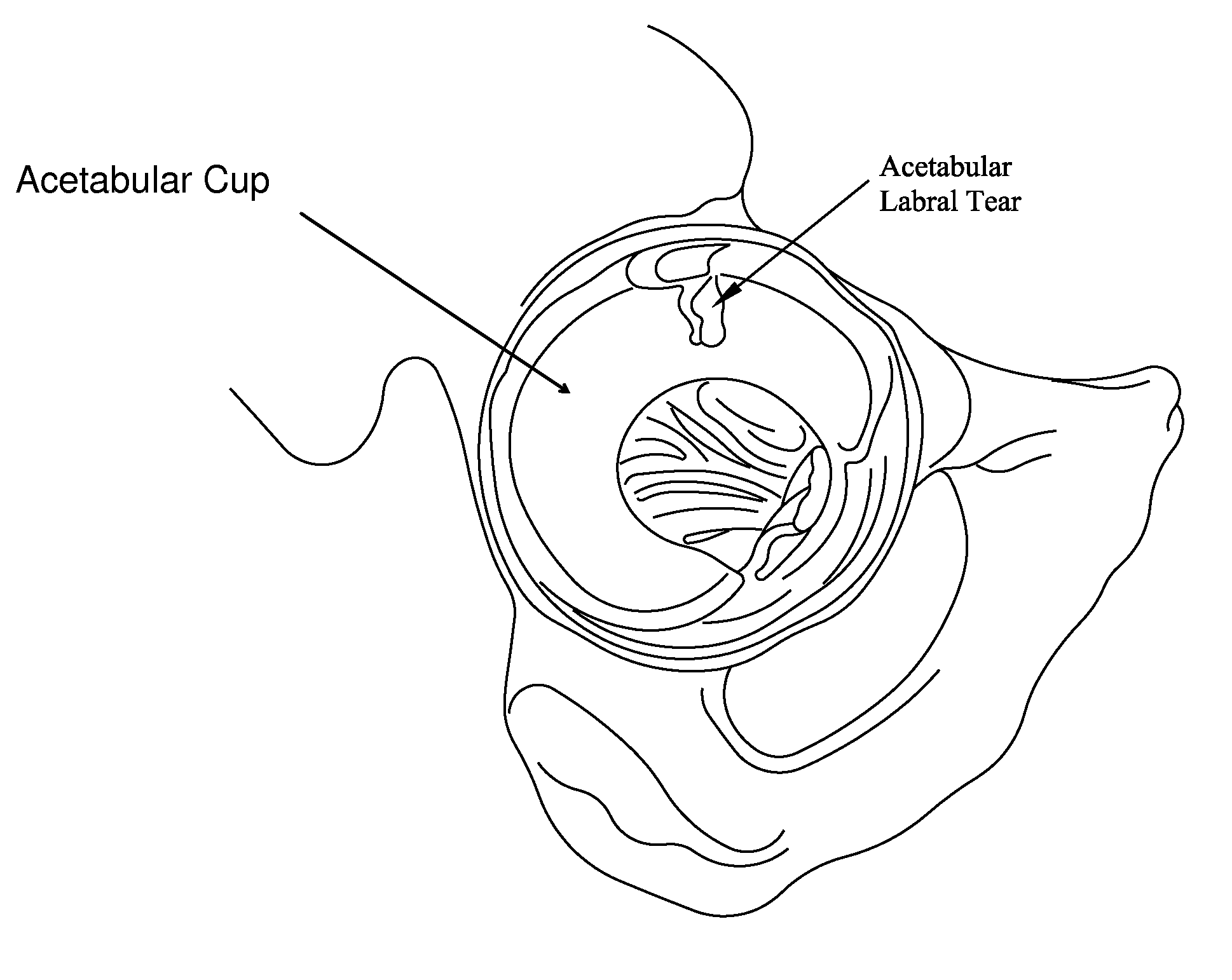 Method and apparatus for treating a hip joint, including the provision and use of a novel suture passer