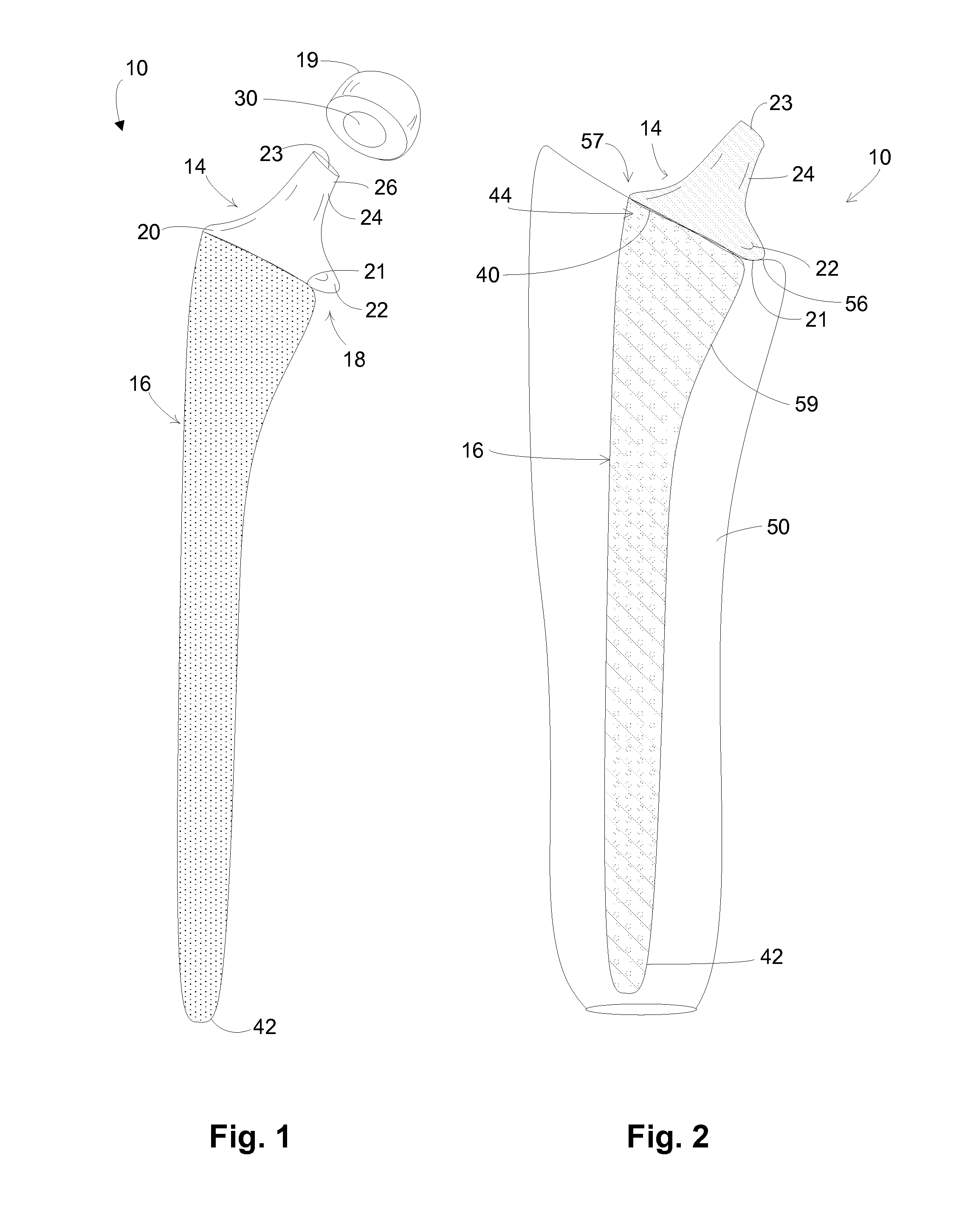 Hip implant with porous body