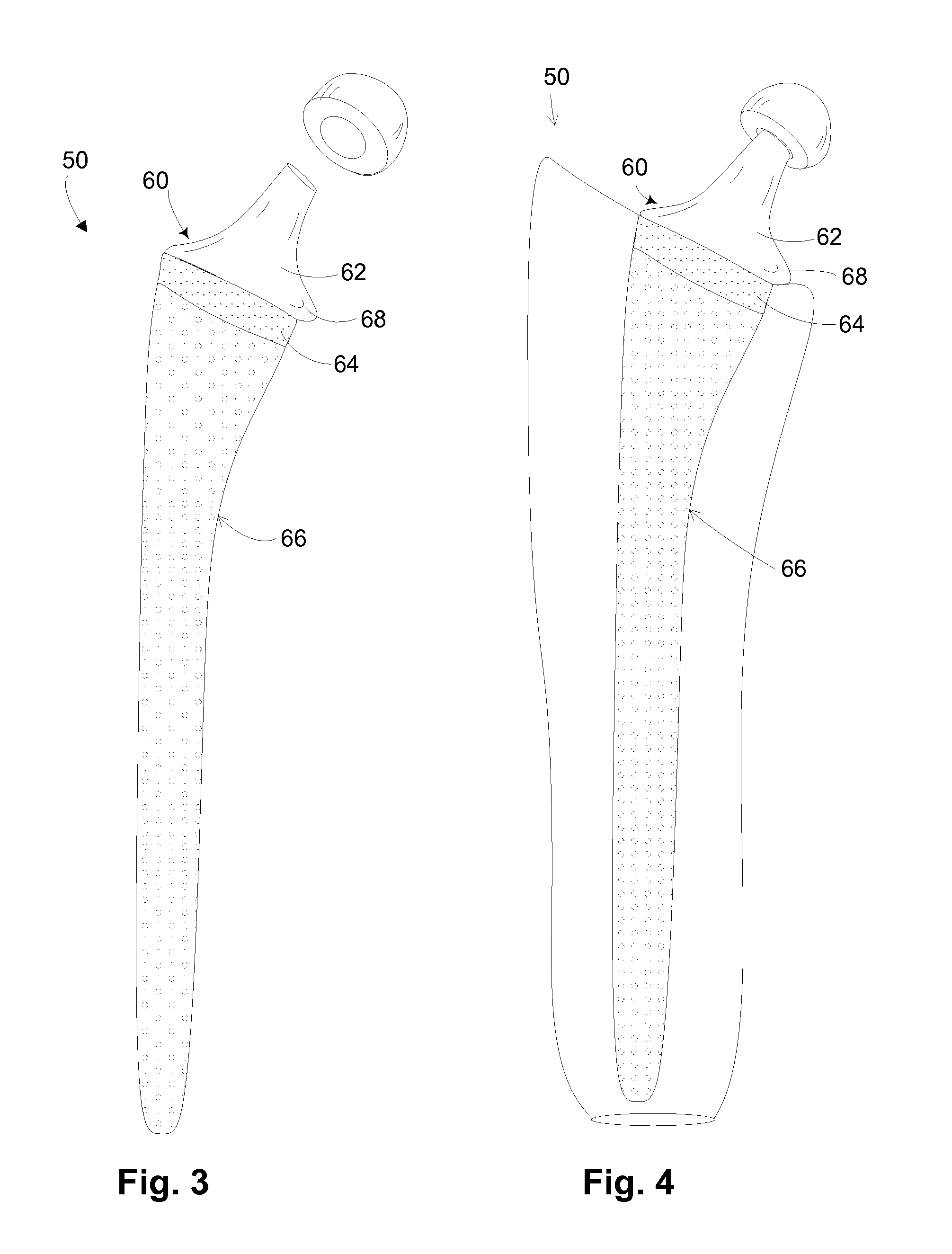 Hip implant with porous body