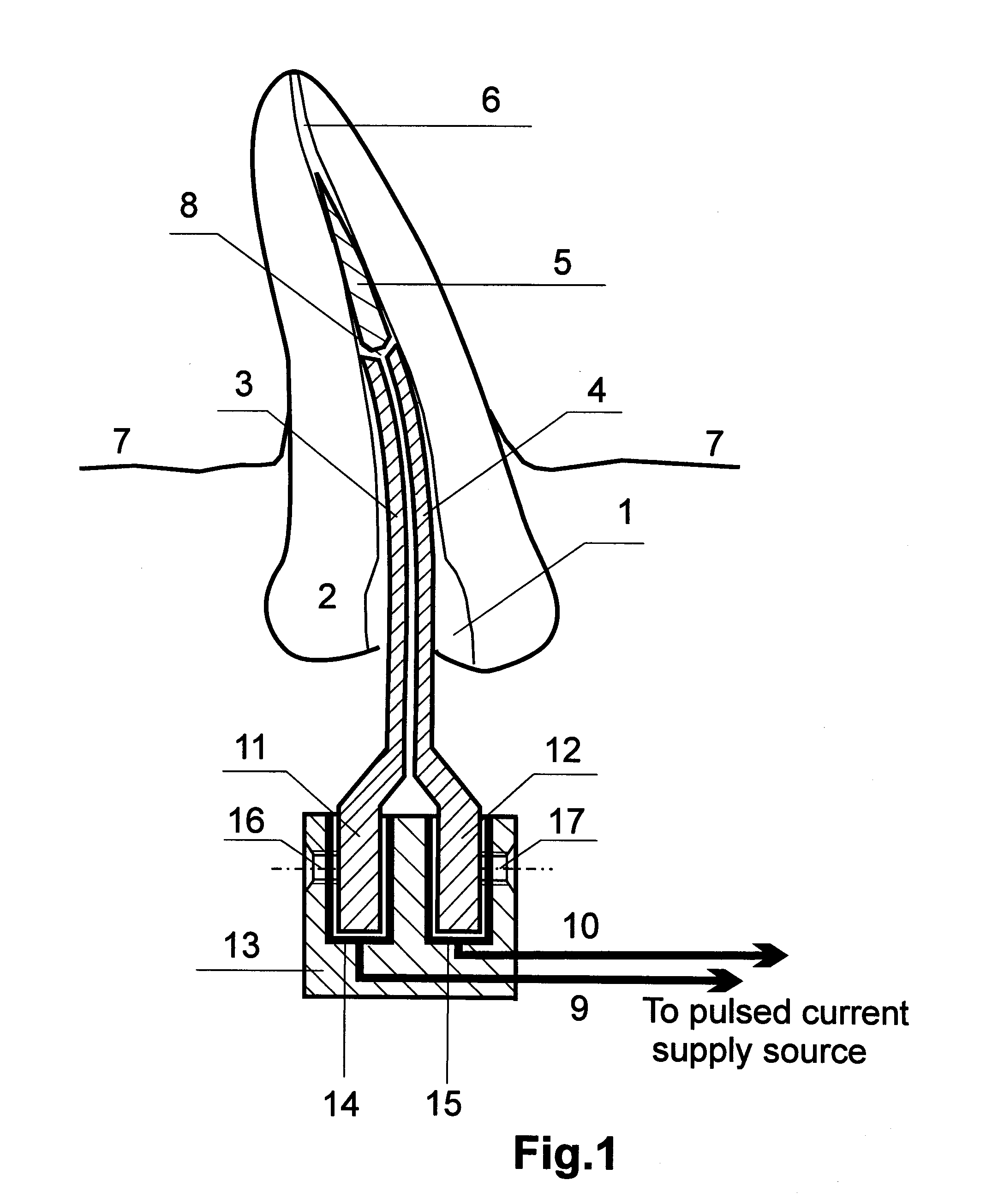 Method for removing a tool fragment from a tooth root canal and an extractor for carrying out said method