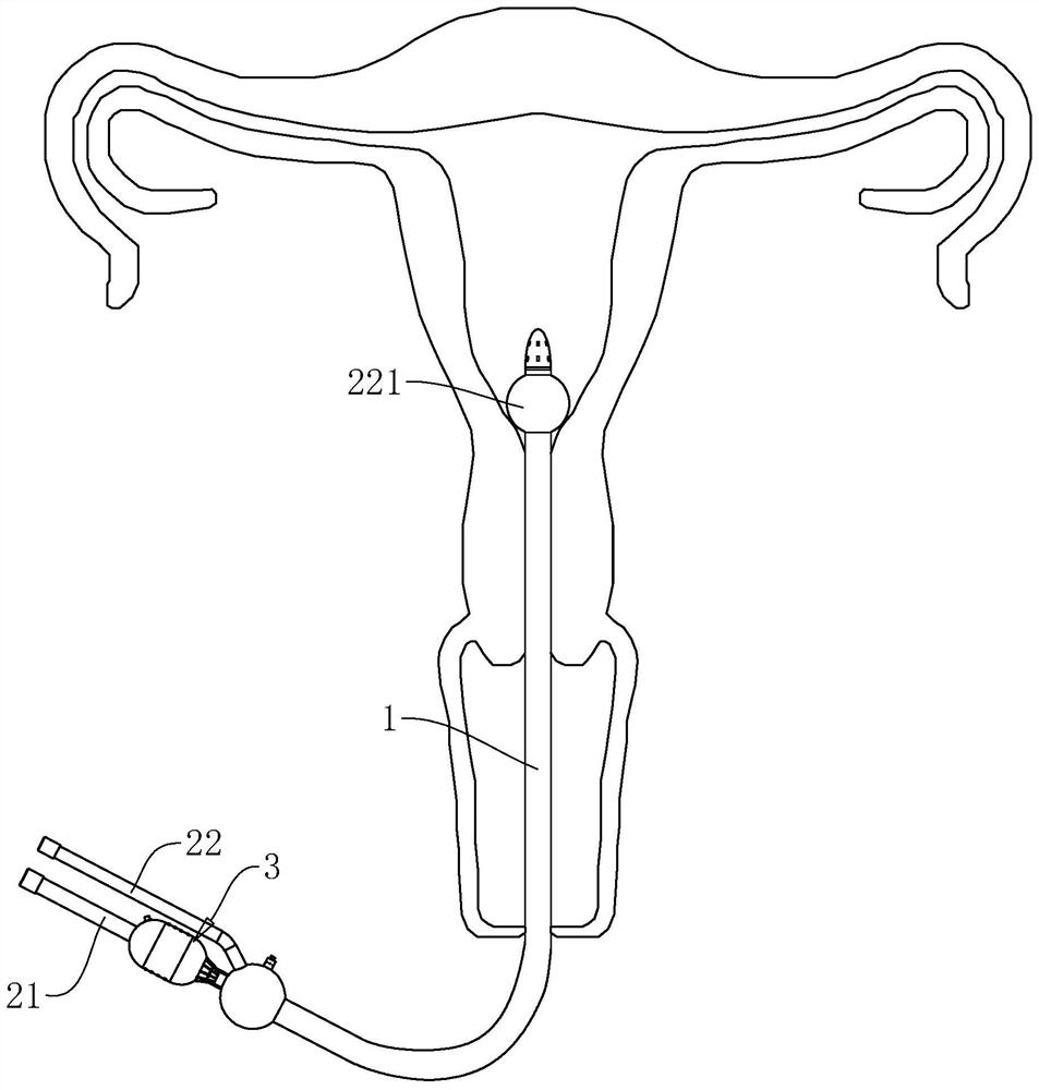 Injection device for salpingography