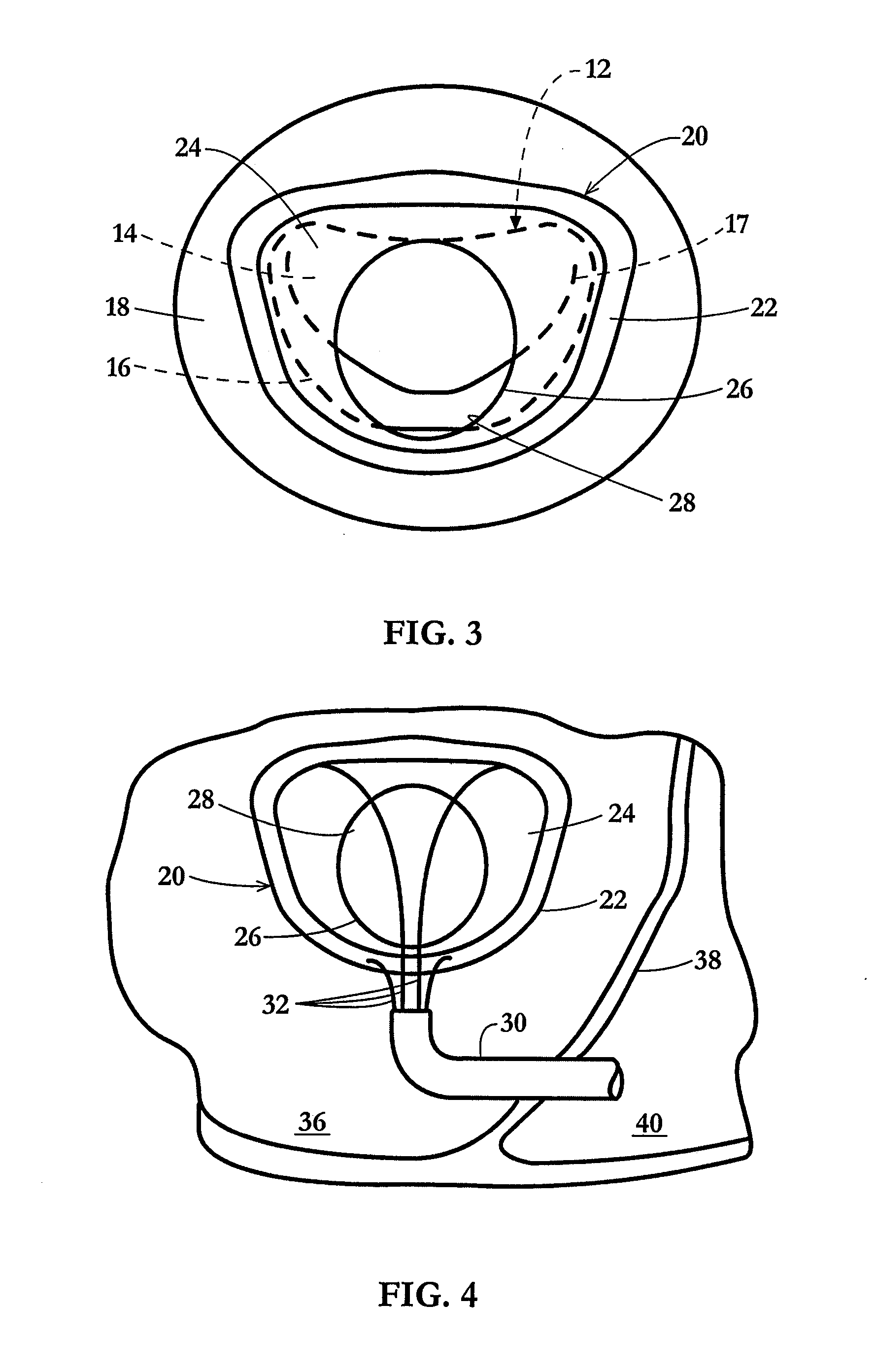 Device and method for temporary or permanent suspension of an implantable scaffolding containing an orifice for placement of a prosthetic or bio-prosthetic valve