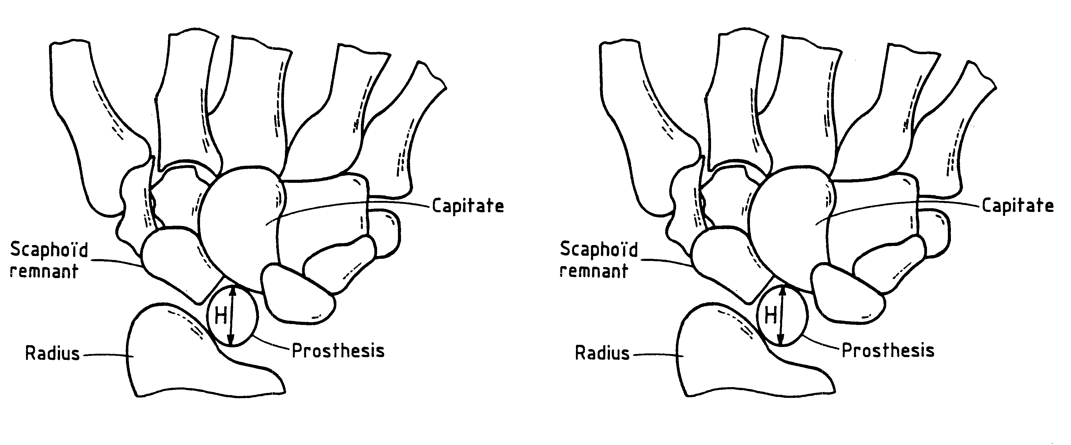 Implant for treating ailments of a joint or a bone