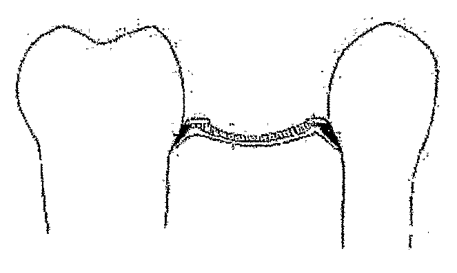 Ceramic Reinforcement Bars For Direct Dental Bridge