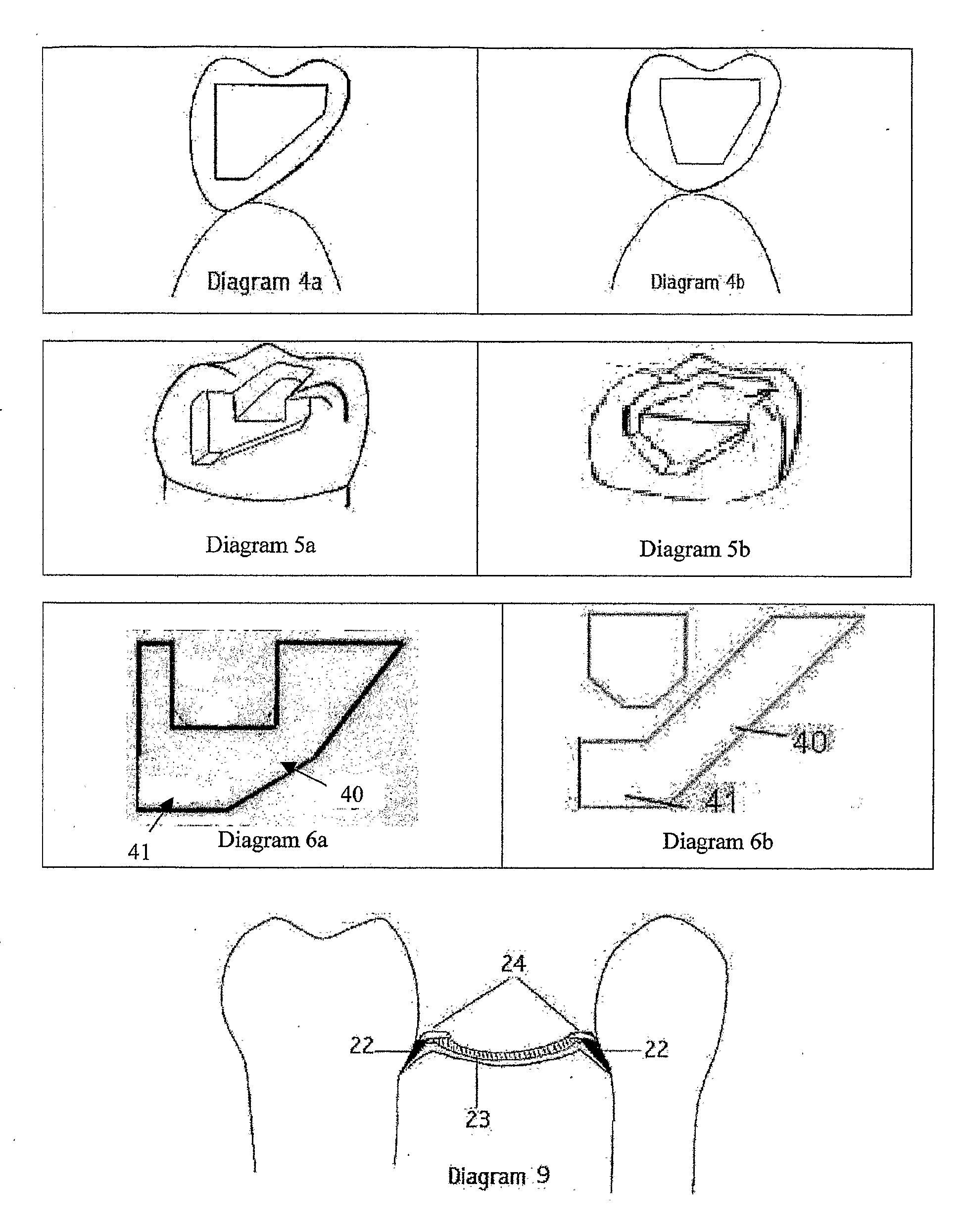 Ceramic Reinforcement Bars For Direct Dental Bridge