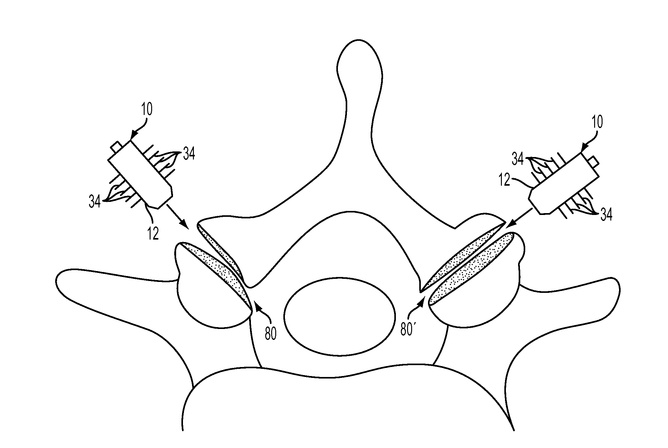 Facet fixation and fusion wedge and method of use