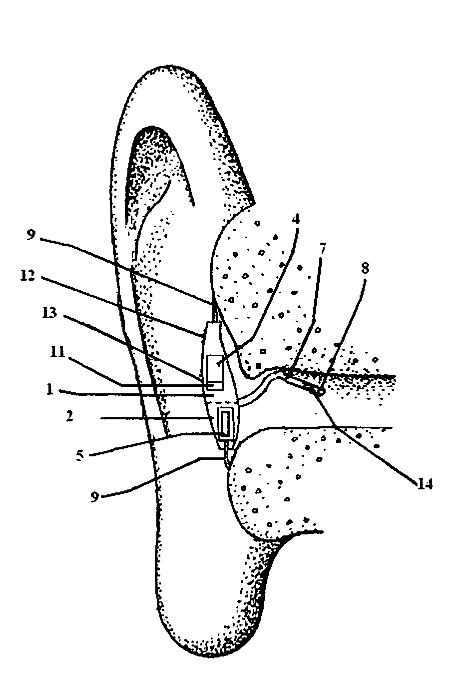 Concha bowl hearing aid apparatus and method