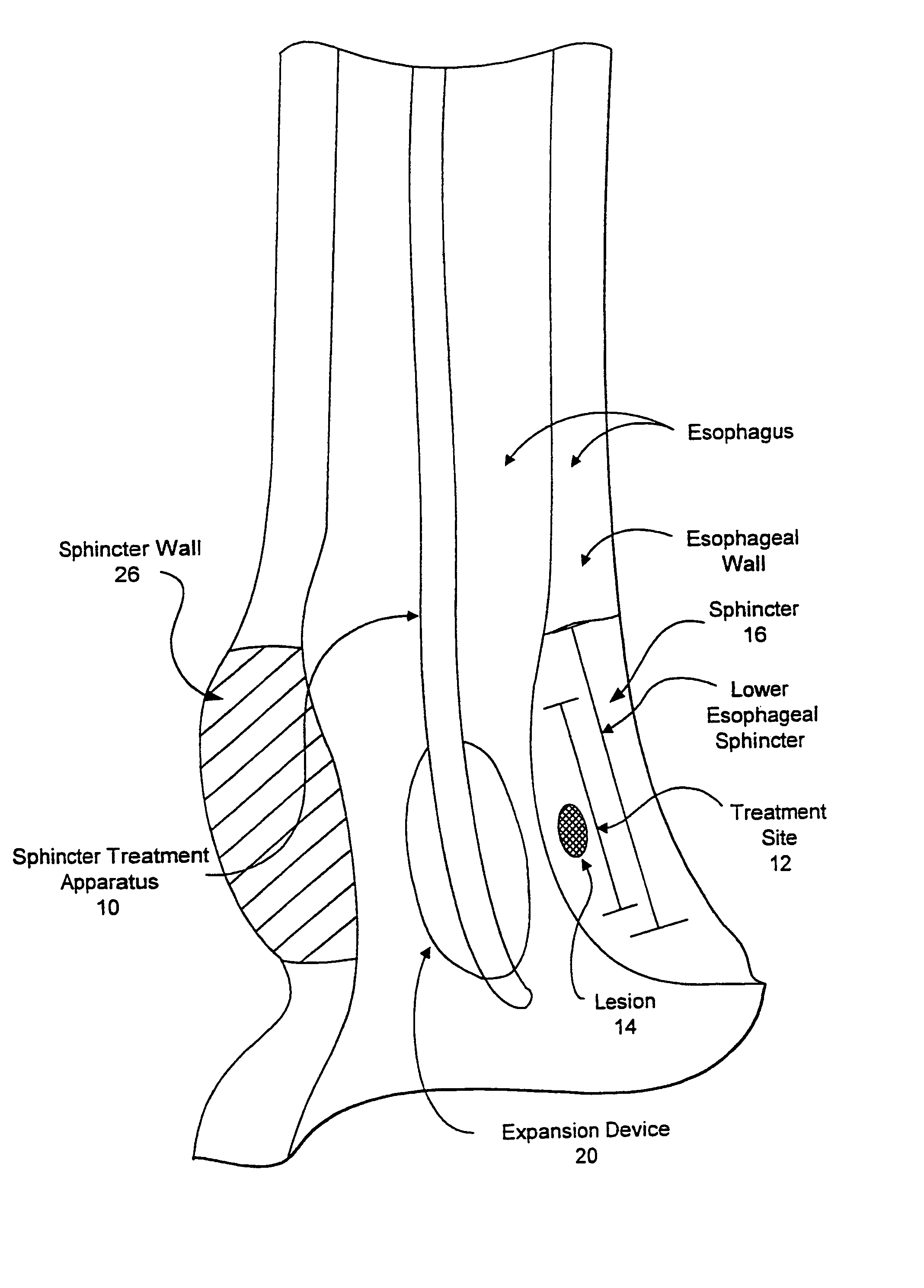 Sphincter treatment apparatus