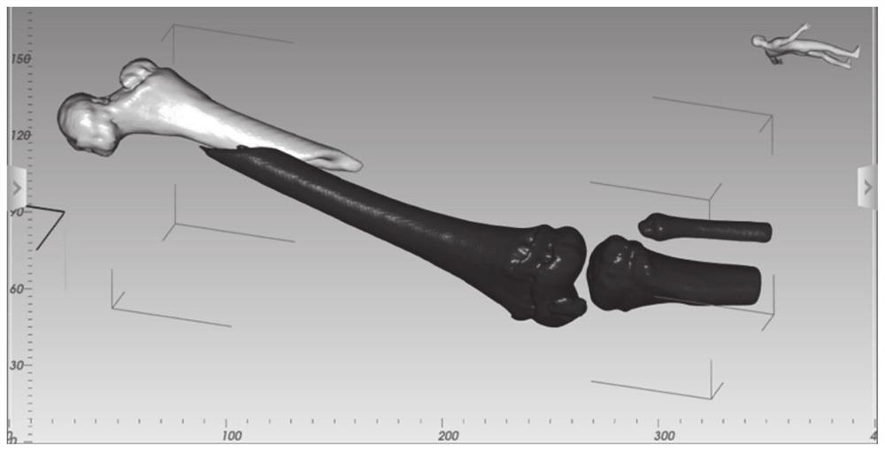 Negative pressure environment bone cement single hole injection fracture fixation system and working method