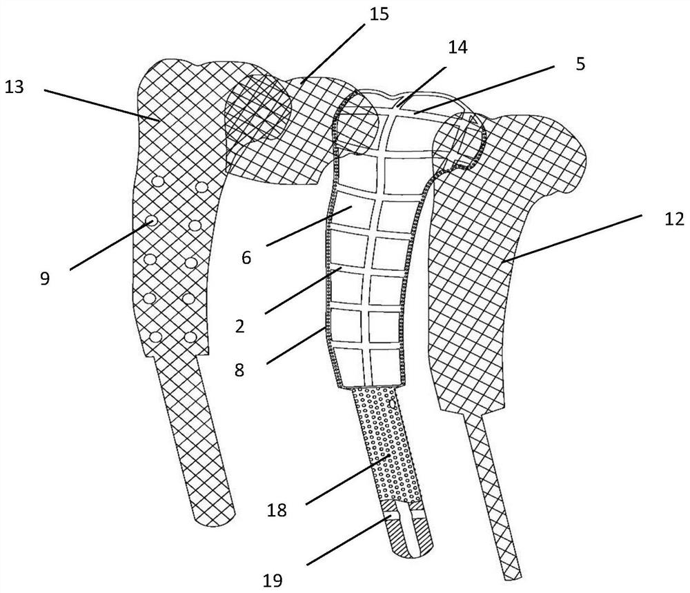 A frame type bone joint prosthesis and its preparation method and application