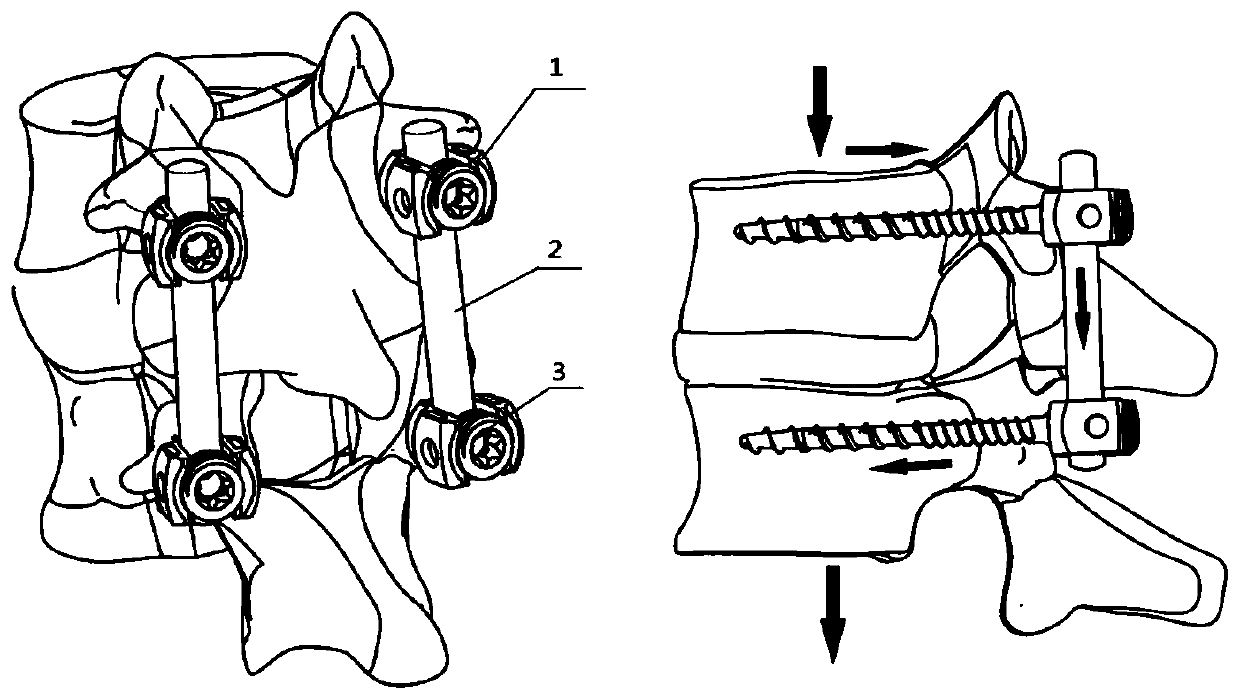 A cobalt-chromium-molybdenum thoracolumbar posterior screw-rod system