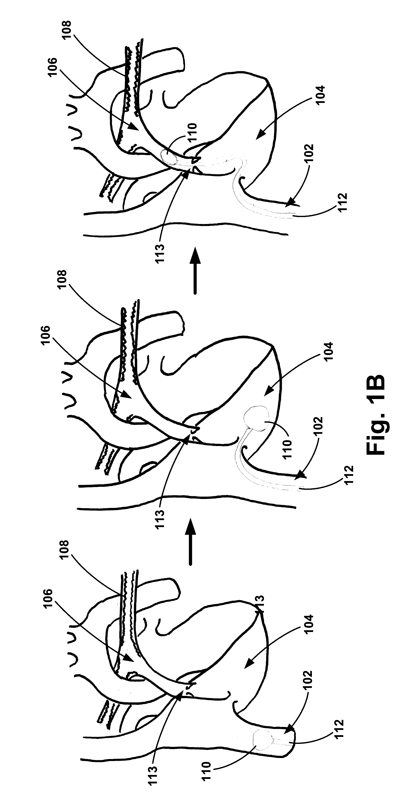 Pulmonary Embolism Apparatus