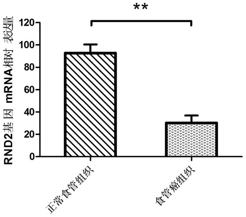 A preparation for detecting, diagnosing or evaluating prognosis of esophageal cancer, a drug for treating esophageal cancer and application of rnd2 gene