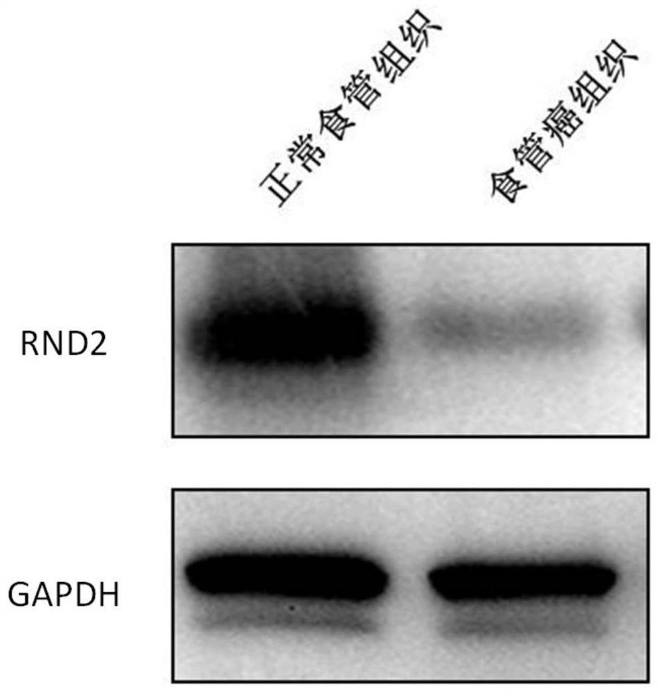 A preparation for detecting, diagnosing or evaluating prognosis of esophageal cancer, a drug for treating esophageal cancer and application of rnd2 gene