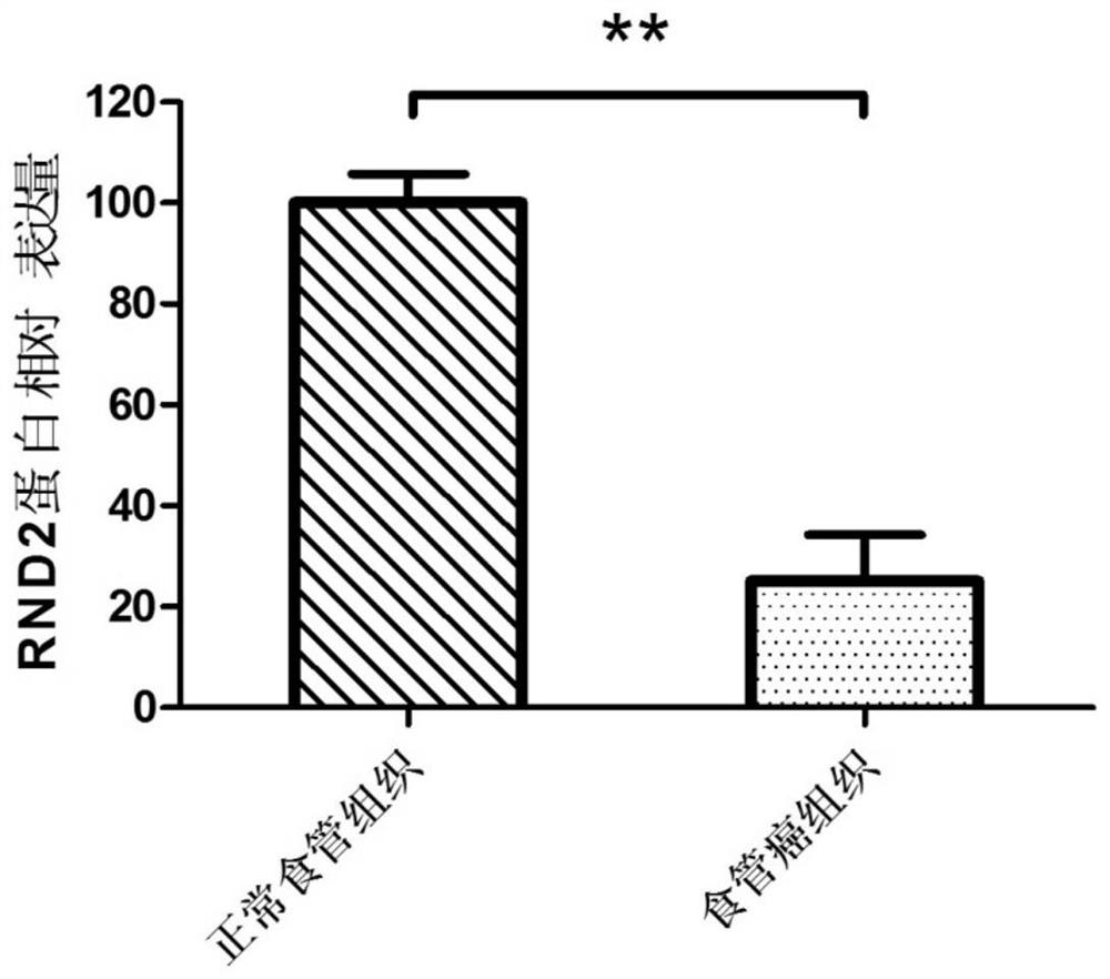 A preparation for detecting, diagnosing or evaluating prognosis of esophageal cancer, a drug for treating esophageal cancer and application of rnd2 gene