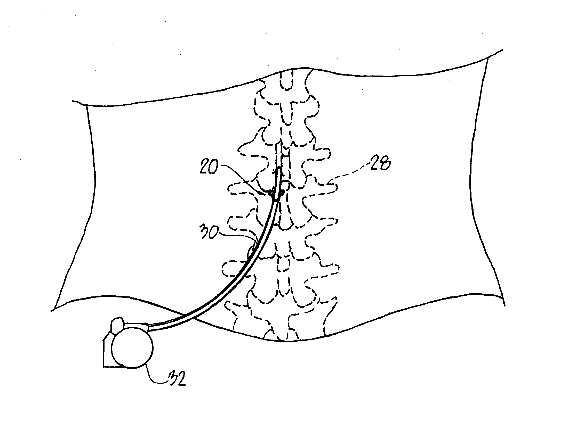 Spinal Cord Stimulator Lead Anchor