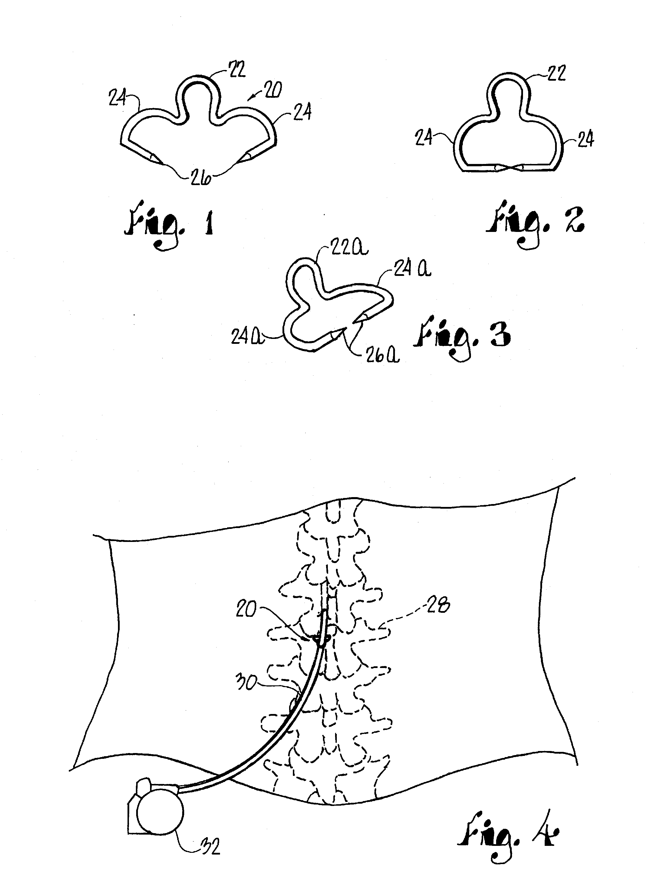 Spinal Cord Stimulator Lead Anchor