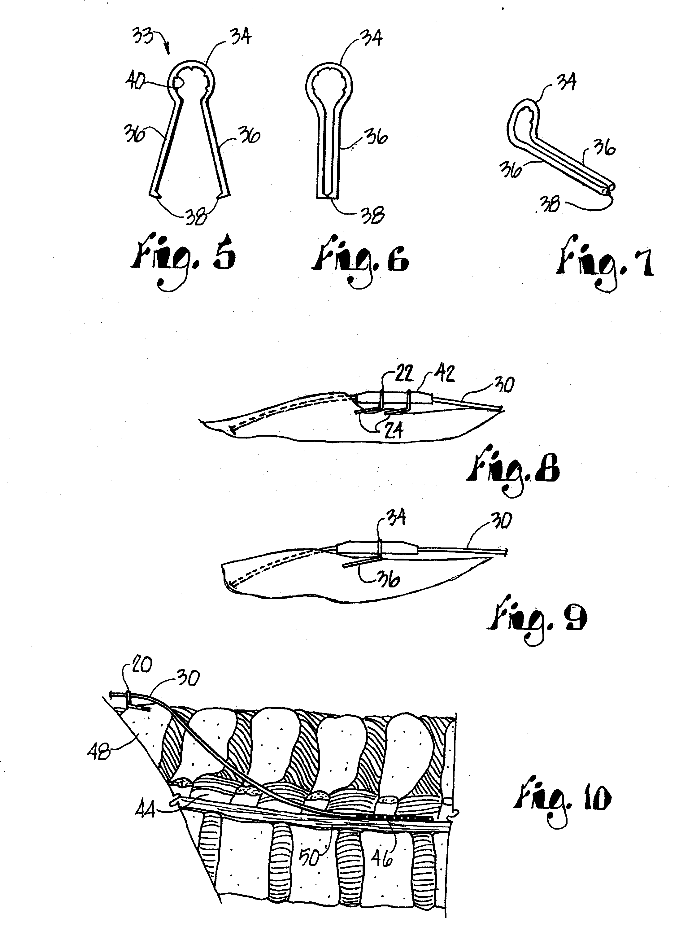 Spinal Cord Stimulator Lead Anchor