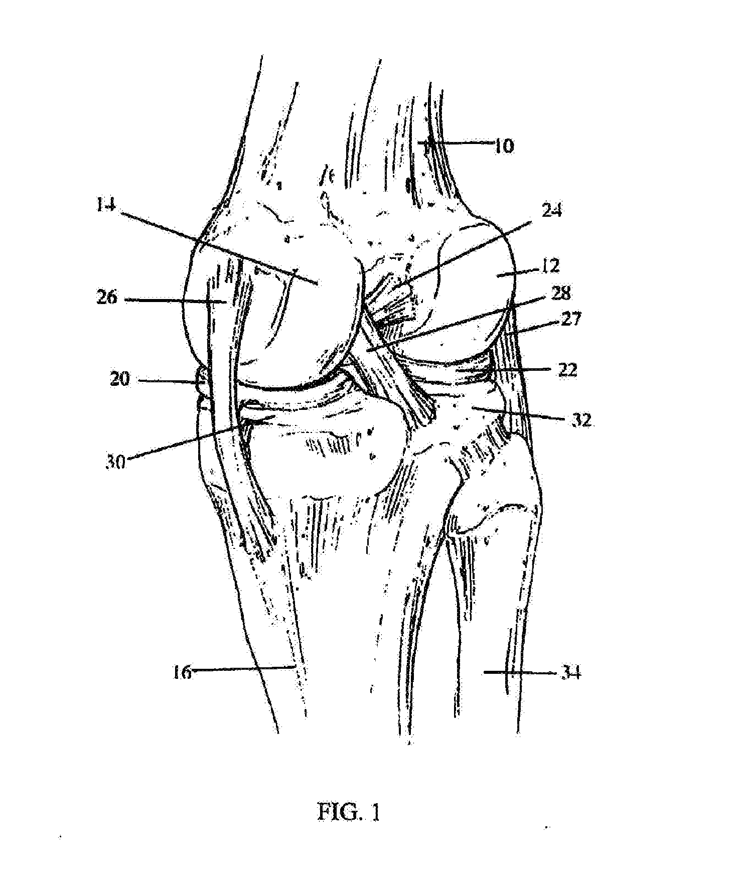 Apparatus and method for sculpting the surface of a joint