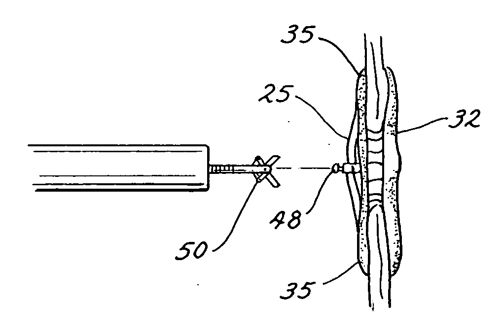 Medical device for occluding a heart defect and a method of manufacturing the same