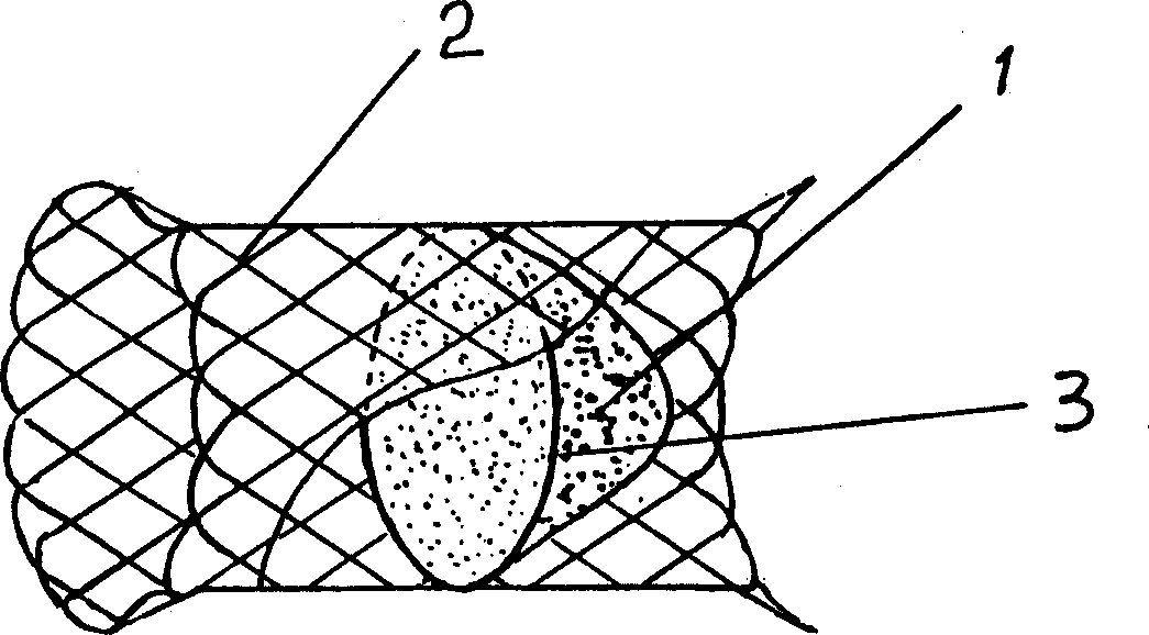 Implantation type thrombus filter